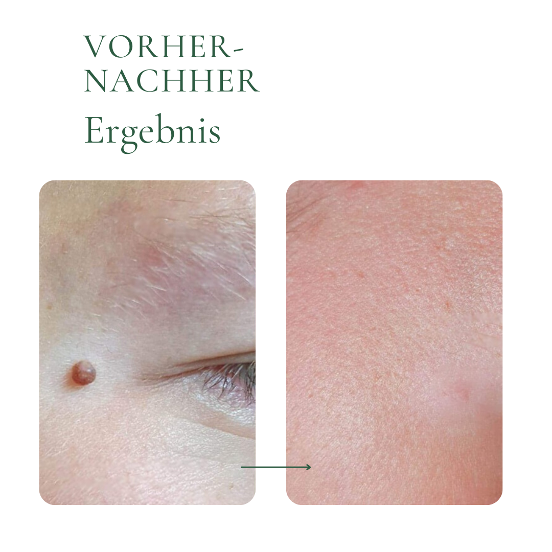 Creamole - 100% natürliche Creme zur Entfernung von Muttermalen, Leberflecken & Warzen