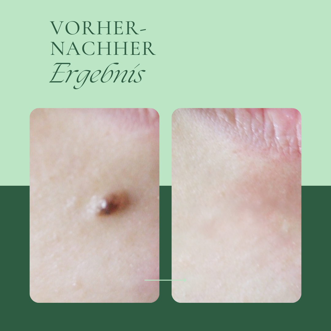 Creamole - Pflanzliche Creme zur Entfernung von Muttermalen, Leberflecken & Warzen