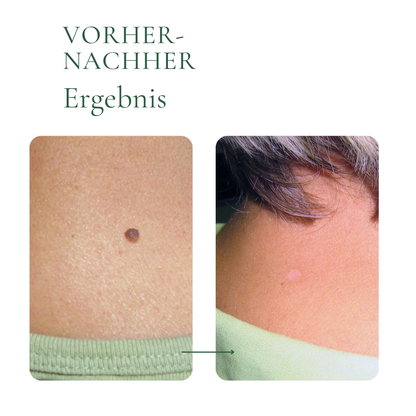 Creamole - 100% natürliche Creme zur Entfernung von Muttermalen, Leberflecken & Warzen