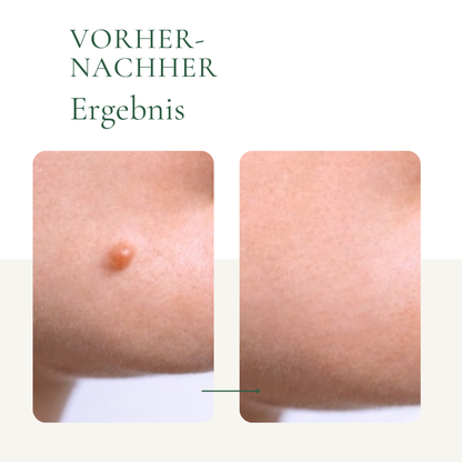 Muttermalentfernung-Vorher-Nachher