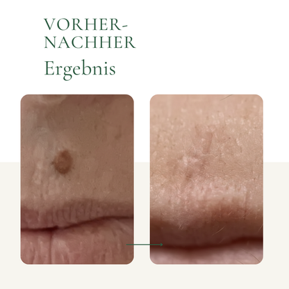 Muttermalentfernung-Vorher-Nachher-2